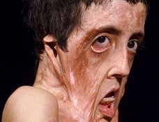 【閲覧注意】顔がグニャリと伸びきった美少女 ― アフガンの貧困が招いた悲劇を克服した愛と生命力