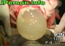 【超・閲覧注意】脳からバレーボールが出てきた女、無事生き延びる