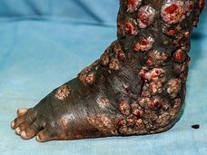 【閲覧注意】癌はまだマシ!? 性器破壊、全身骨化、血管漏出… 世界で最も恐ろしい10の病