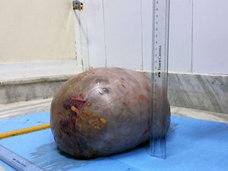 【閲覧注意】5カ月で7キロまで膨張した超巨大腫瘍がヤバすぎる!「数日遅かったら死んでいた」=インド