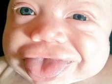 口からニョキニョキ、舌だけが2倍の速さで成長する奇病 ― ベックウィズ・ヴィーデマン症候群