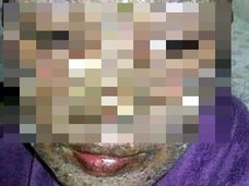 【閲覧注意】全身の肉が腐り、ボロボロ剥げ落ち…! 抗うつ剤の副作用が目も当てられないヤバさ