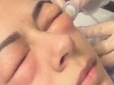 YouTubeで話題の「人面ふうせん」! 美しくなるために、炭酸ガスを目元に注射するカルボキシセラピーとは?