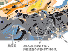 肺が真っ黒なボロ雑巾状態に!1日30本40年間タバコを吸い続けるとこうなる