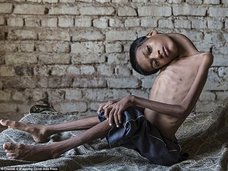 【奇病】首がグニャリと180度曲がってしまった少年=インド 母親にも呪われ続けた壮絶人生
