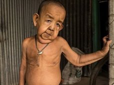 4歳なのに80歳の風貌! 差別と貧困に喘ぐリアル「ベンジャミン・バトン」の過酷な人生=バングラデシュ