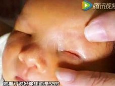中国で“眼球のない赤ちゃん”が誕生! 深刻な環境汚染が原因で「100人に2人」先天性異常発症か