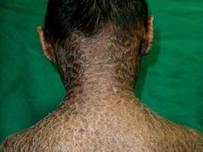 【衝撃】ウロコで全身を覆われた姉弟 ― 皮膚がひび割れ、剥がれ落ちる難病と徹底的差別の実態=インド