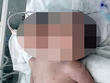 【閲覧注意】生まれた我が子は“双頭”の赤ん坊だった… 原因不明の奇形児続発に戦慄!=インド