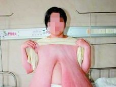 【閲覧注意】オッパイが無限に大きくなり続ける奇病「巨乳症」 ! 超特大“Pカップ”も…!