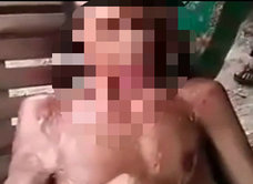 【閲覧注意】顔面がドロドロに溶けすぎて首がなくなった男 ― 口を閉めることもできず…アシッドアタックの恐怖