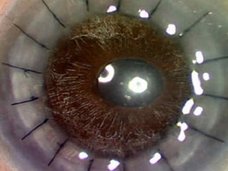 【閲覧注意】人間離れした“神々しすぎる目”になる疾患「角膜ジストロフィー」が美しい