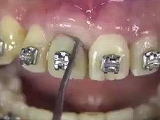 【閲覧注意】精神的にキツイ映像発見! 最新抜歯技術「ベネックス抜歯システム」がヤバイ・痛い・グロい!