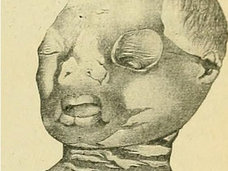 【閲覧注意】「ハーレクイン型魚鱗癬」の女の子 ― 真っ赤な目と“白ヒビの肉体”が動き出す=インド