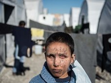 空爆で両目が完全に潰れたシリア少年! カメラに向けられた“瞳なき眼差し”に心を揺さぶられる!