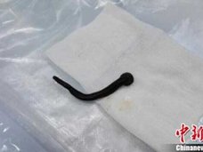 生水と一緒に体内に!? あの吸血生物が喉の中で4倍サイズに成長「窒息死に至る危険性も……
