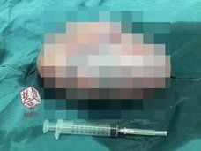 12歳女児の卵巣から6キロの異物が……中国で“リアルピノコ”巨大奇形腫の出現が相次ぐ