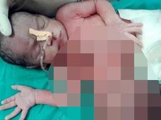 【閲覧注意・奇形】腹から「もうひとつの頭」が生えた赤ん坊 ― 肥大した頭部と苦悶の表情=インド