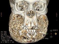 【奇病】顎が超巨大化、現代美術彫刻になった女性 ― 謎の難病「ケルビズム症」とともに生きて