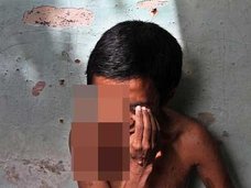 【閲覧注意】腫瘍の中に埋もれた“目玉”がギョロリ…!どこまでも垂れ下がる右目をもつ男=フィリピン