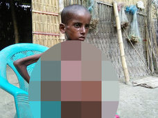 【閲覧注意】爆発しそうなほど“超巨大化する腹”をもつ7歳少年! 「両側性胸水」で歩行も食事もできない絶望的病状=インド
