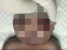 【超・閲覧注意】この世で最も不気味で悲しい顔 ― 飛び出した眼球、ゼリー状の血液… 奇病「レイン症候群」の赤ん坊が絶望的!