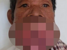 【閲覧注意】30年間一度も歯医者に行かないとこうなる!? 歯肉が巨大化、完全に口が塞がりヤツメウナギになった男=カンボジア