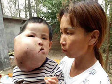 安楽死を願う親も……巨大腫瘍に苦しむ中国の子どもたち「頼みの綱は募金」