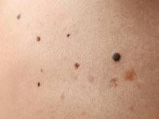 ほくろに悪性の皮膚がんメラノーマ(悪性黒色腫)が発生する可能性は意外に低い