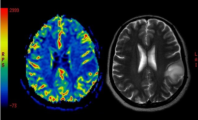 【科学】鼻呼吸と口呼吸、脳への影響に圧倒的な差があることが判明！ 記憶力から寿命、顔も激変！の画像3