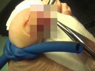 【閲覧注意】“巻き爪”の手術映像が痛すぎて絶叫レベル！ 爪を引き抜き、肉塊を切り取って…驚愕の光景