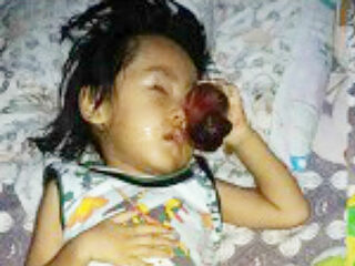 顔面に巨大腫瘍を持つ3歳の少年が手術せずに日本の漢方薬を選んだ後に死亡＝インドネシア