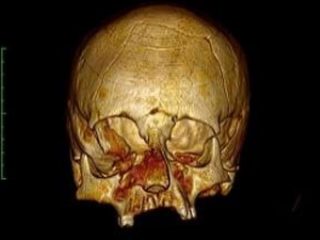 宇宙人にしか見えない謎の「頭蓋変形の少年の骸骨」3体がクロアチアで発掘される！ 頭の形それぞれ異なり…！