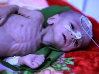 飢餓に苦しむアフガニスタンの子供たち！ 100万人が“骨と皮”に… タリバン支配で人道危機が深刻化
