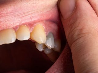 「フッ素は有毒、銀歯は口が電池になる」イケメン歯科医が告発！（インタビュー）