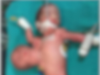 【閲覧注意】胸から別の“頭と手“が生えた奇形性双生児、分離手術に成功！ 無償で行われた手術の過程がスゴい！＝インド