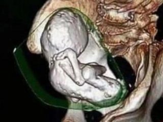 73歳の女性の子宮から35歳の「石の赤ちゃん」を発見