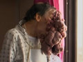 【閲覧注意】ポルトガルのエレファント・マンの“壮絶”手術映像 ― 20年間男を苦しめた5キロの顔面腫瘍を切除