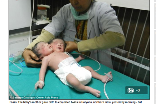 頭2つの赤ちゃん生まれる＝インド　世界で600例しかない双頭児の悲しき定めとは？の画像1