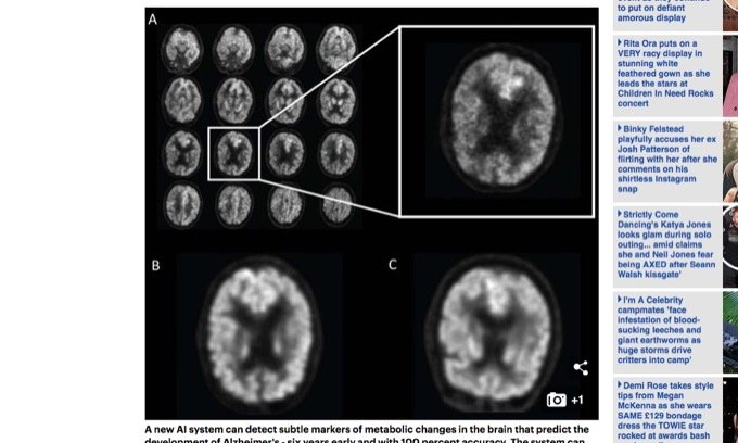 「世界アルツハイマーデー」　AI診断で発病6年前に100%の精度で異常を発見可能の画像2
