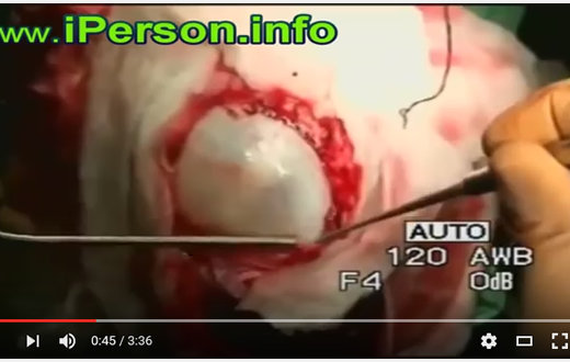 【超・閲覧注意】脳からバレーボールが出てきた女、無事生き延びるの画像2