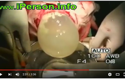 【超・閲覧注意】脳からバレーボールが出てきた女、無事生き延びるの画像3
