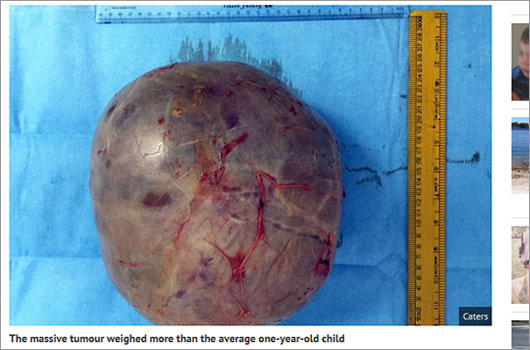 1606_tumor_01.jpg