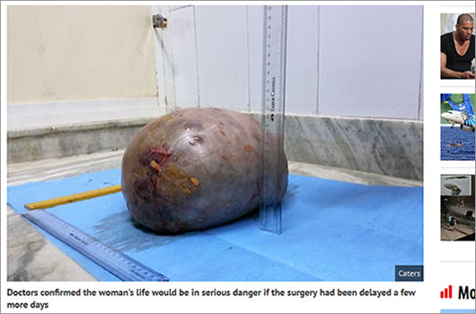 1606_tumor_03.jpg