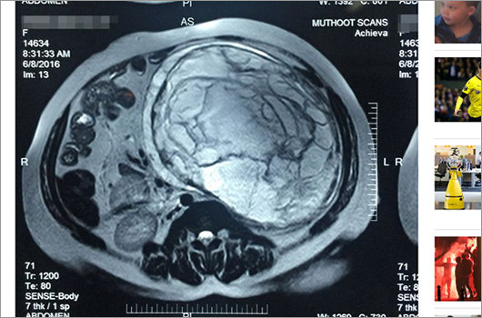 1606_tumor_04.jpg