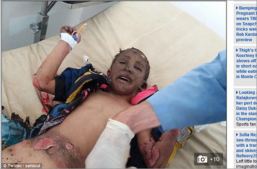 【閲覧注意】フェイスブックが削除した「ナパーム弾」写真、現在でも民間人25人が死亡。少年少女の肌は焼けただれる=シリアの画像3