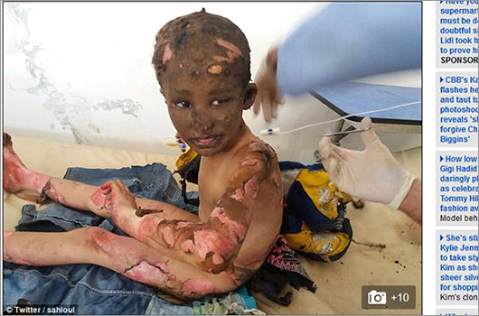 【閲覧注意】フェイスブックが削除した「ナパーム弾」写真、現在でも民間人25人が死亡。少年少女の肌は焼けただれる=シリアの画像4