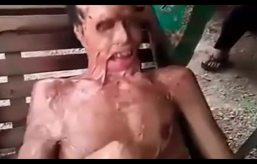 【閲覧注意】顔面がドロドロに溶けすぎて首がなくなった男 ― 口を閉めることもできず…アシッドアタックの恐怖の画像1