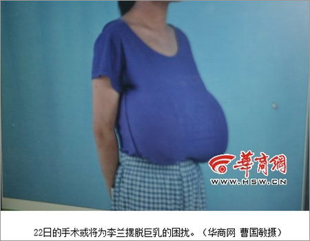 【閲覧注意】オッパイが無限に大きくなり続ける奇病「巨乳症」 ! 超特大Pカップも…!の画像3