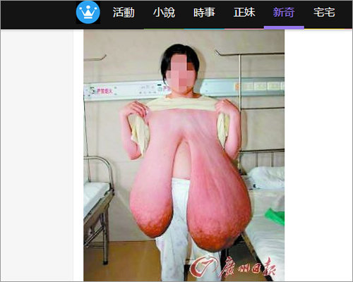 【閲覧注意】オッパイが無限に大きくなり続ける奇病「巨乳症」 ! 超特大Pカップも…!の画像6